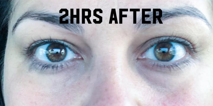 Before and after skincare transformation using Dermakis premium products for clearer skin.