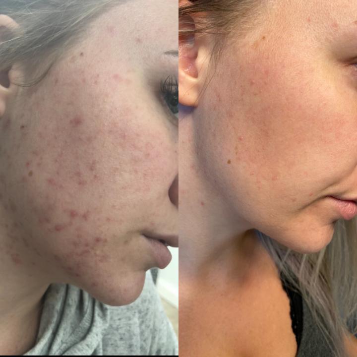 Before and after image showcasing successful acne treatment results with Dermaki products.
