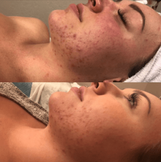 Close-up of skin showing acne improvement after one week using Dermaki products.