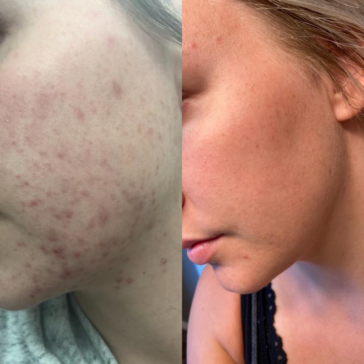 Before and after image showing clear skin results from Dermakis Acne-Clarifying Line.