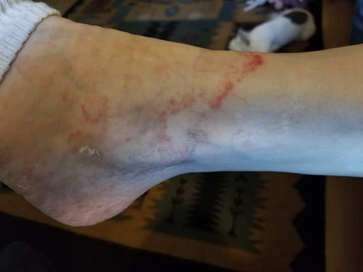 Before image of an ankle showing skin condition, highlighting need for professional skincare solutions.