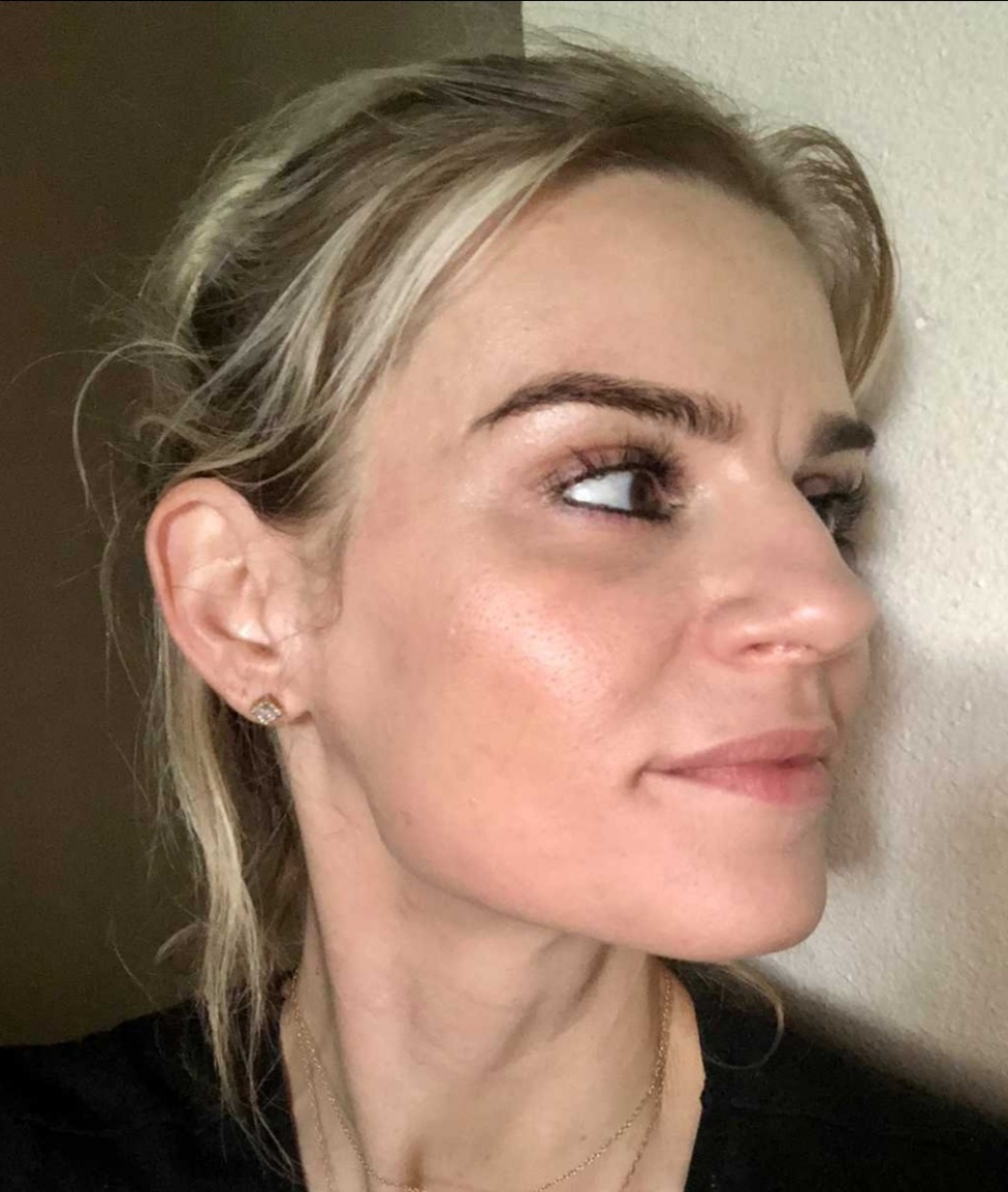 Rebeccas skin improvement after using Dermakis acne-claring products for one month.