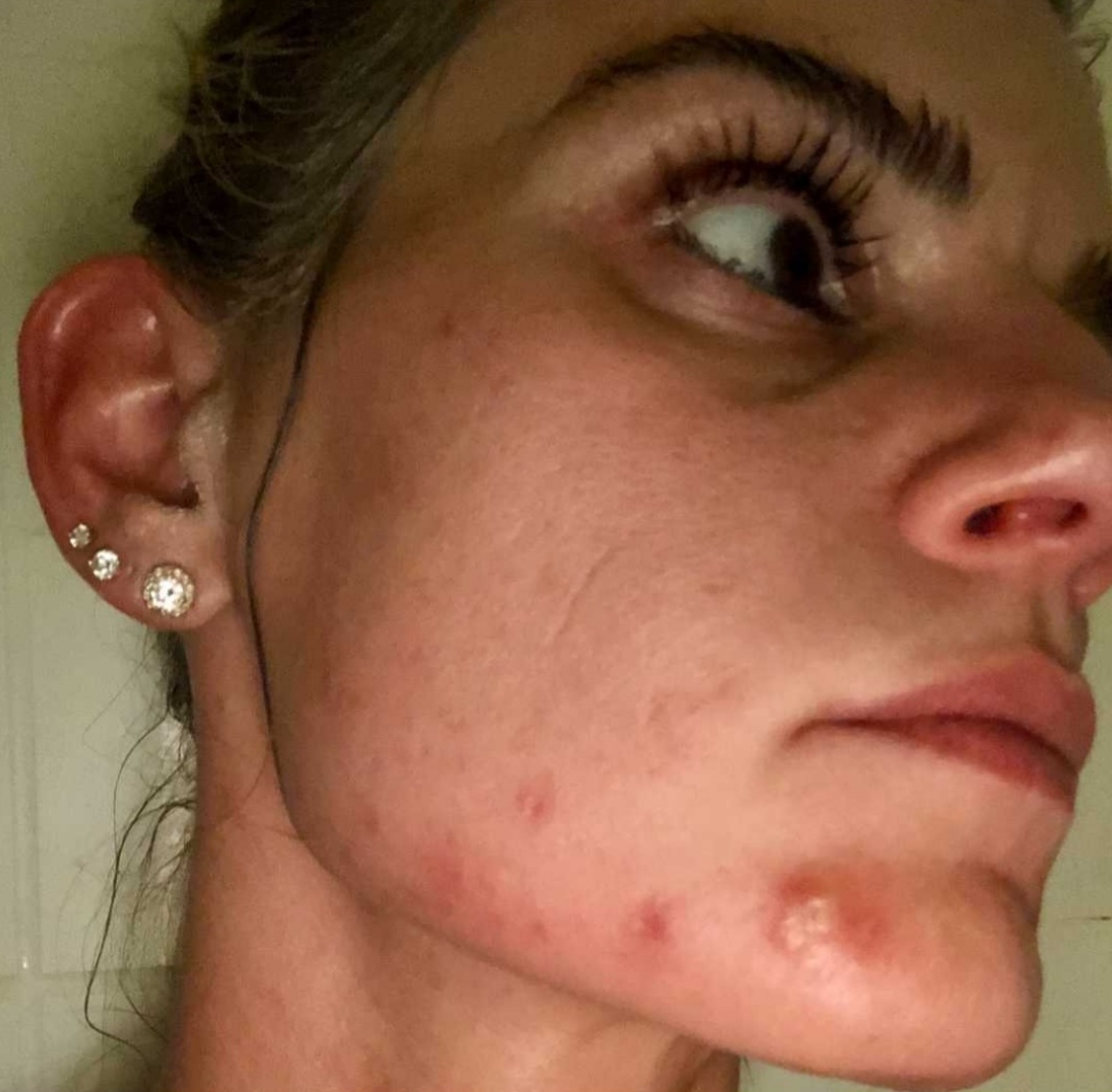 Before photo of Rebecca showing acne problems, highlighting the need for effective skincare solutions.