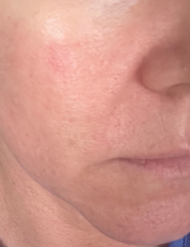 Acid peel burn healing after 47 hours, treated with Dermaki Soothe for skin recovery.