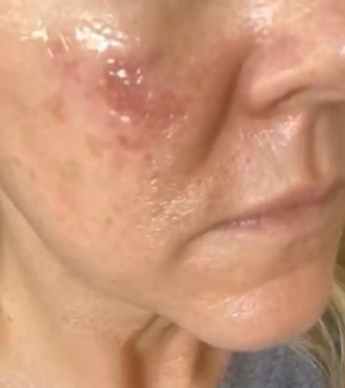 Close-up of skin irritation from acid peel treatment showcasing the importance of professional skincare.