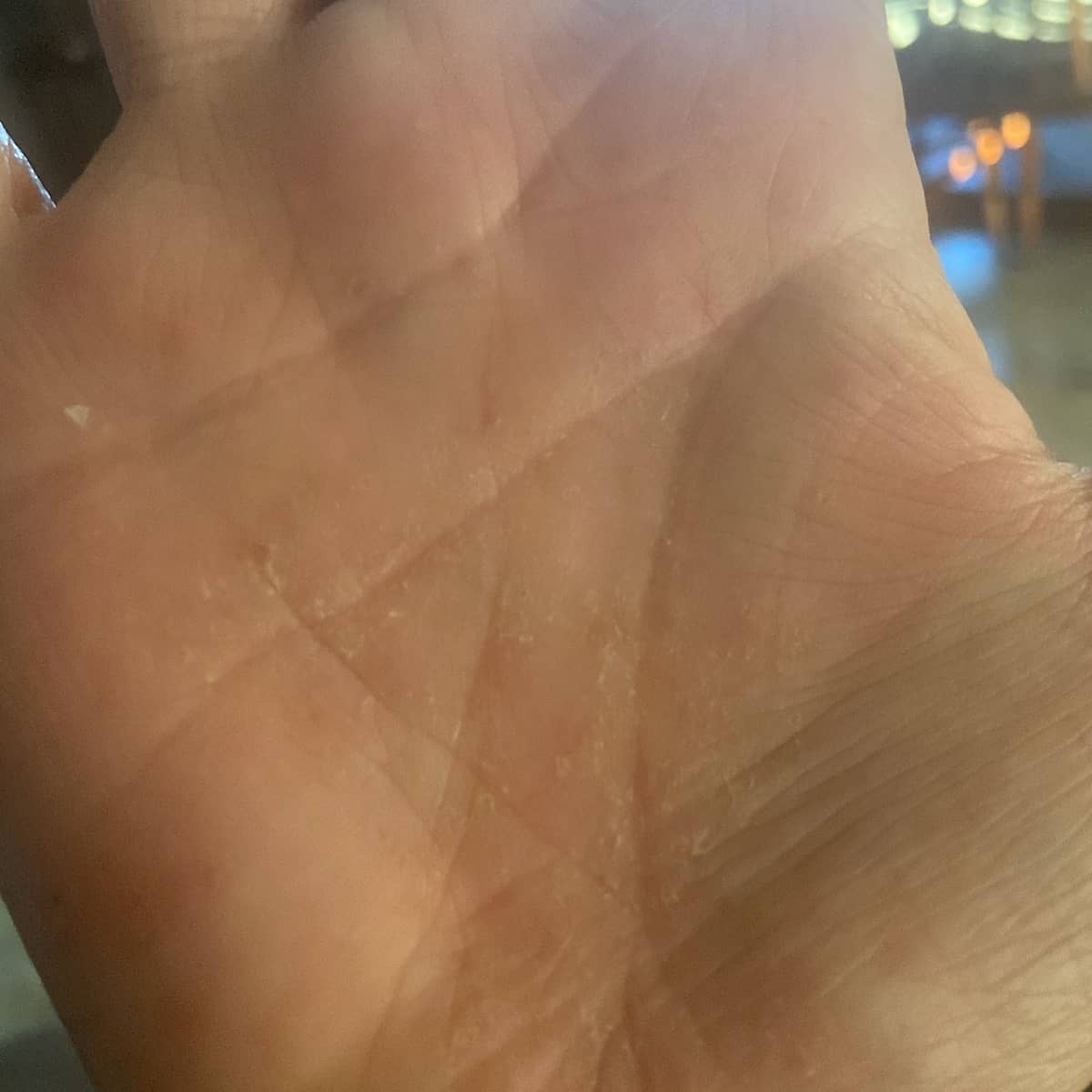 Before and after image showing contact dermatitis improvement with Dermaki Soothe product.