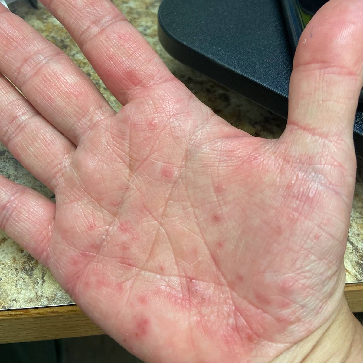 Before image of contact dermatitis showing irritated skin, highlighting skincare needs for sensitive skin.
