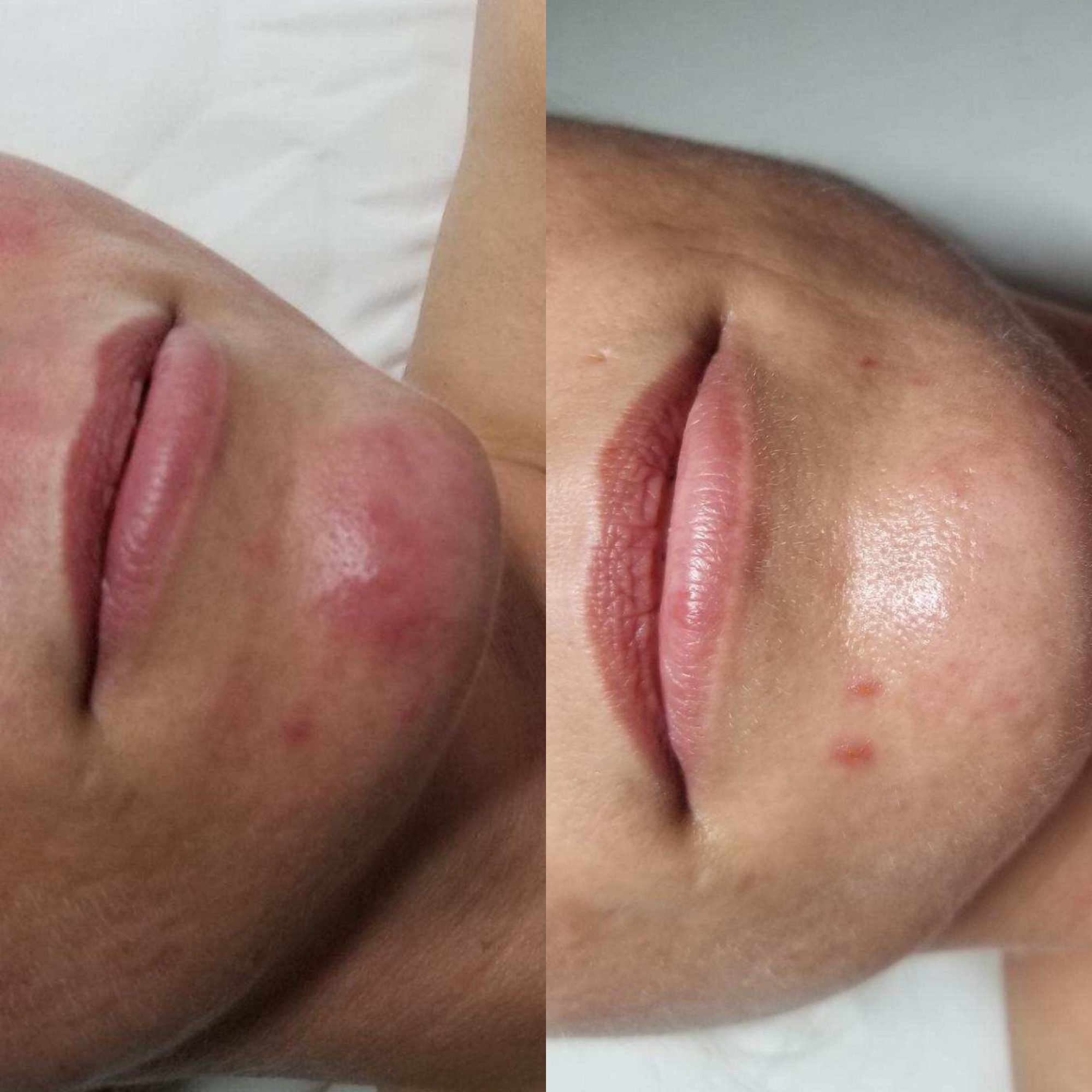 Acne facial treatment with Dermaki products for clear, healthy skin. Perfect for acne-prone skin types.