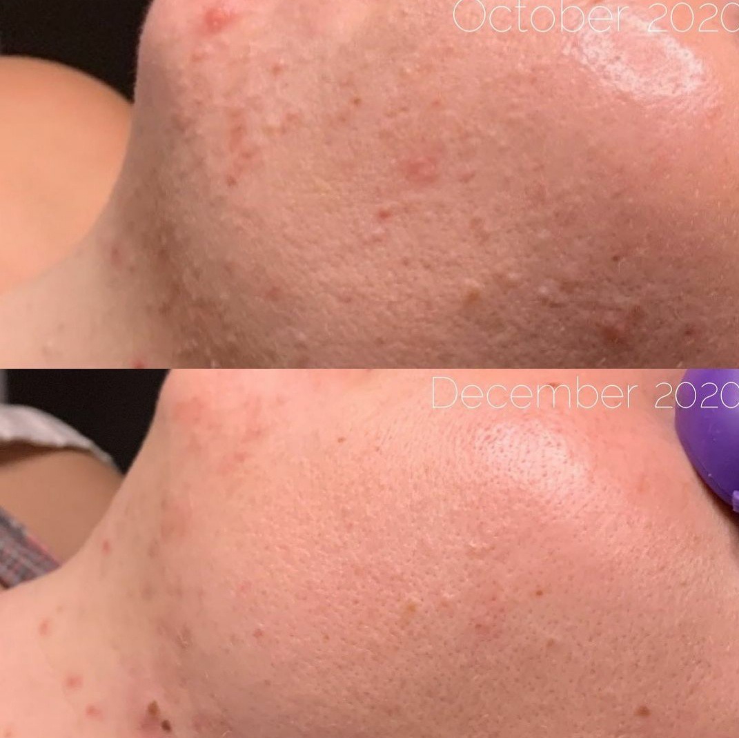 Before and after results showcasing the effectiveness of Dermakis Acne Kit on clear skin transformation.