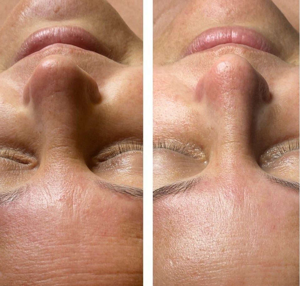 Anti-aging facial treatment showcasing rejuvenating skincare products for youthful skin.