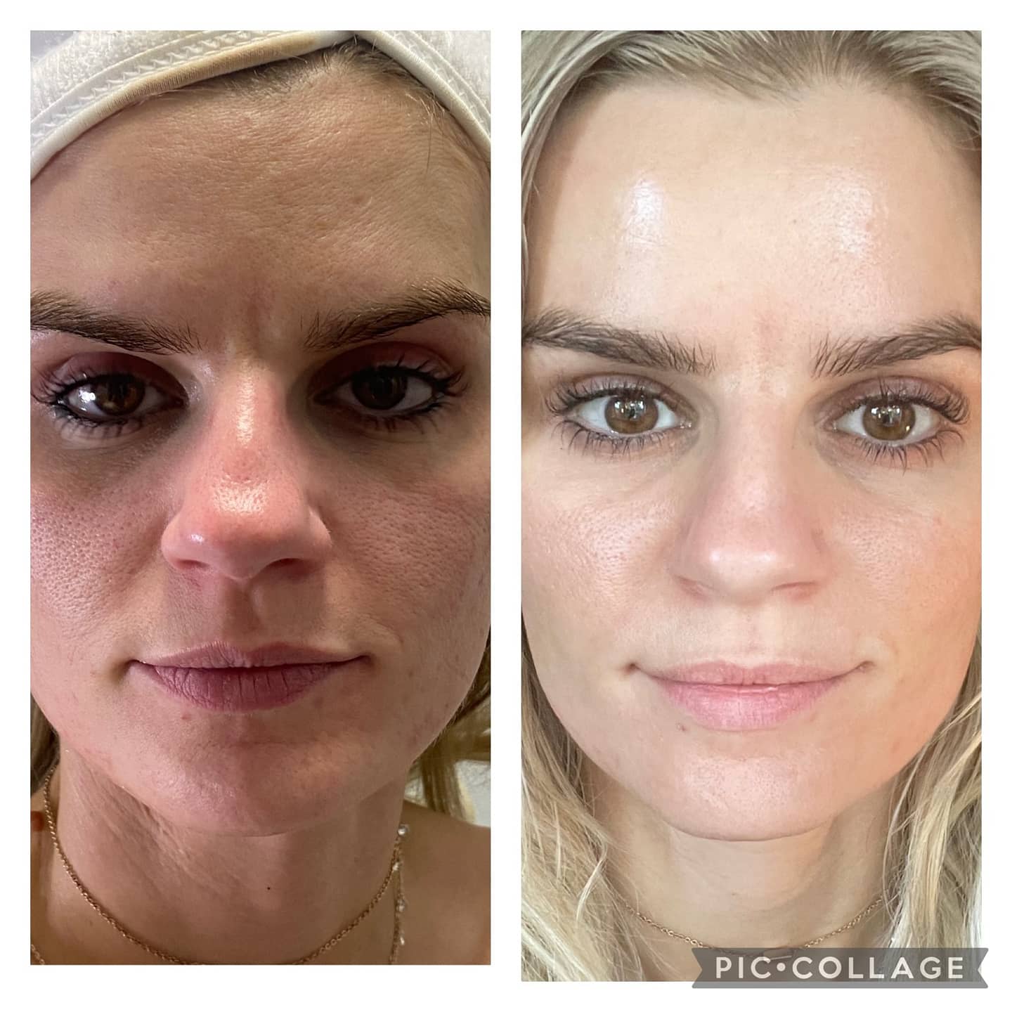 Before and after comparison of skin using Dermaki-Plex, showcasing visible improvement in texture and clarity.