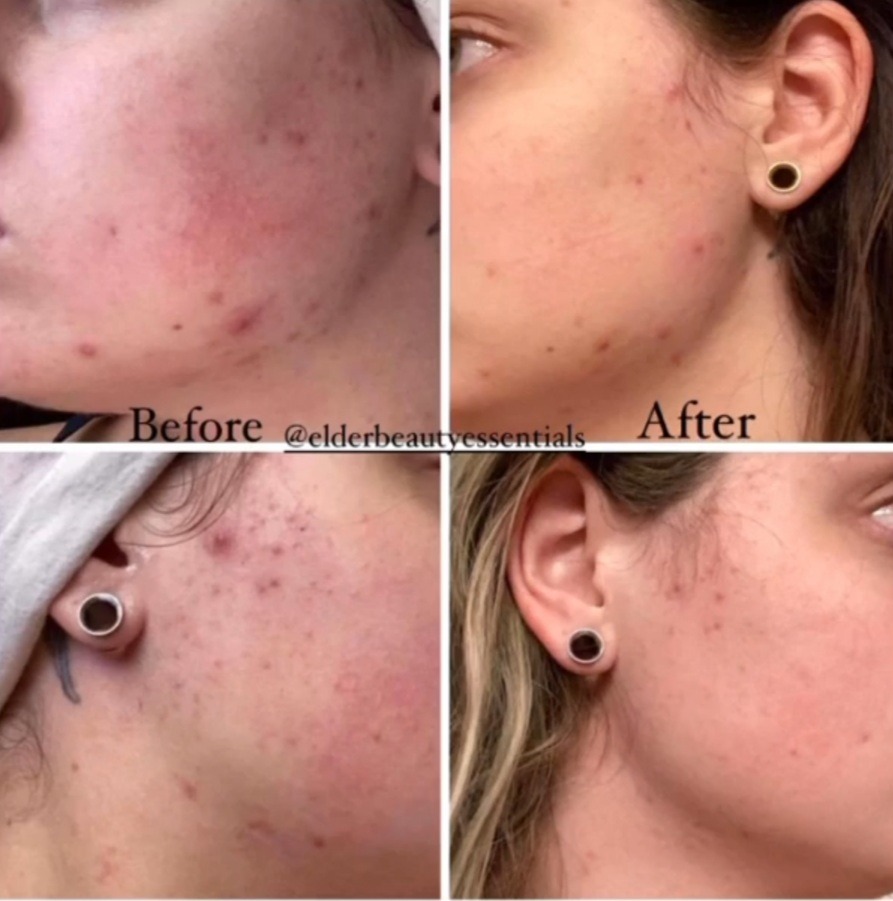 Before and after results of Dermaki-Plex showcasing skin improvement and anti-aging benefits.