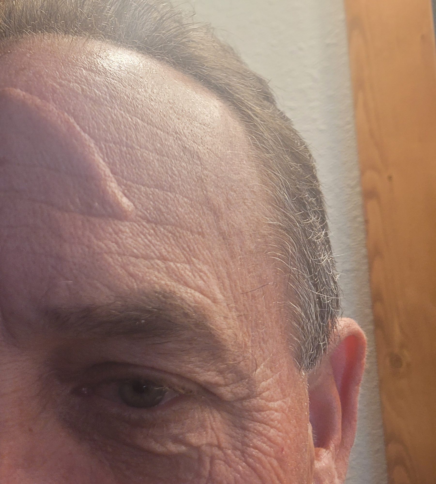 Drews glowing skin after micro-needling treatment, showcasing healthy, rejuvenated complexion.