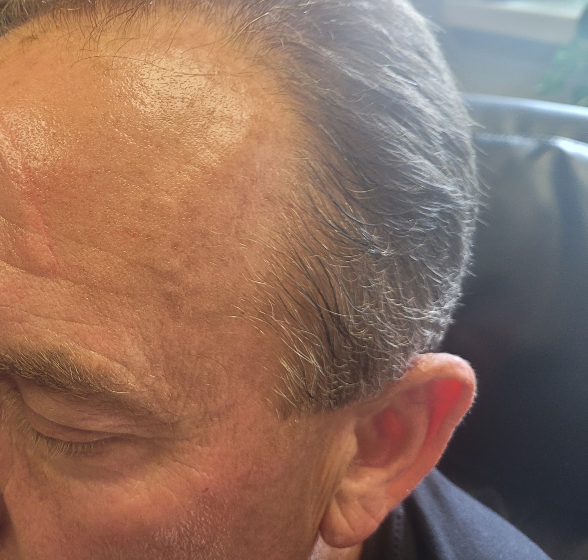 Drews glowing skin after micro-needling treatment, showcasing Dermakis professional skincare results.