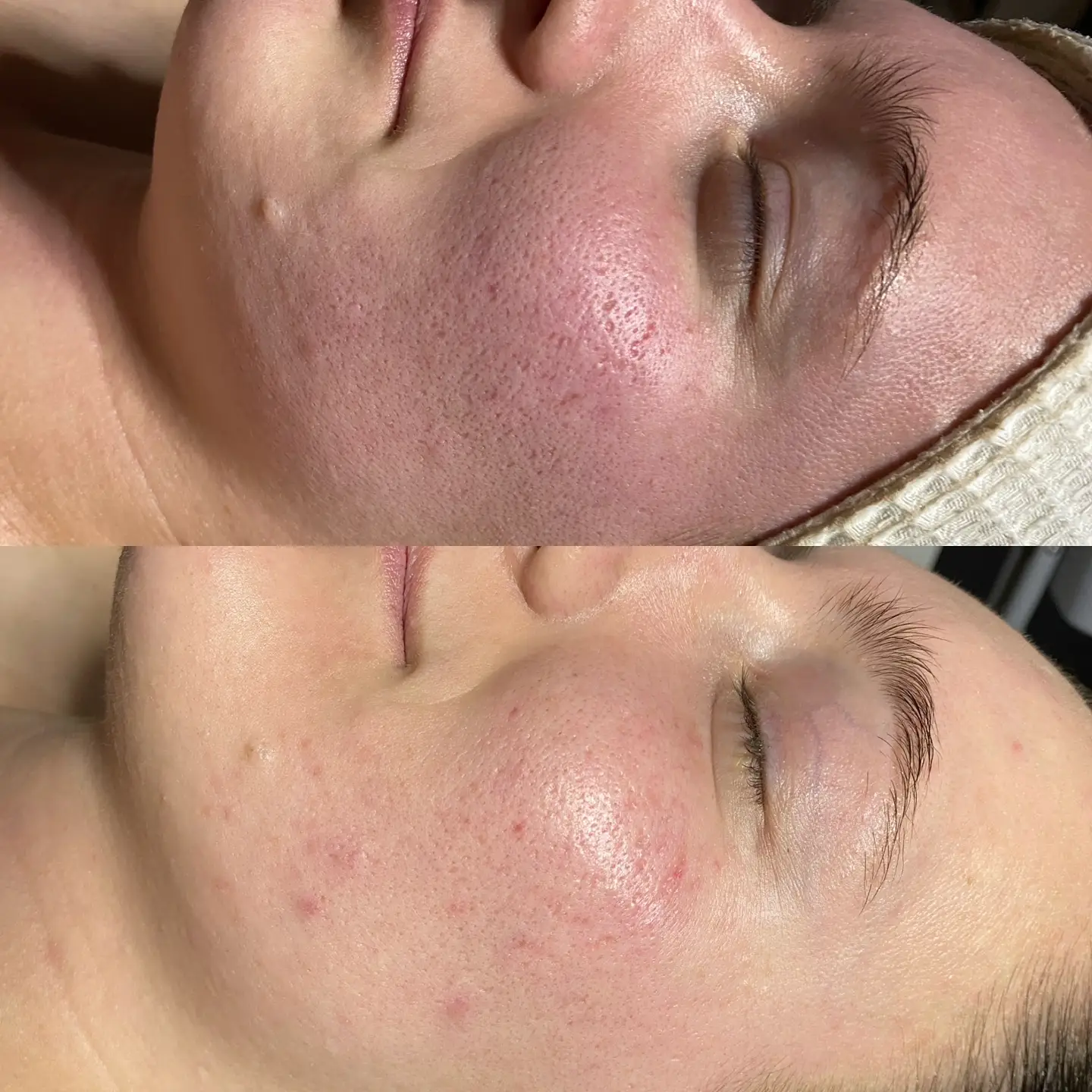 Dermaki Plex Ultrasound device for professional skincare treatments, enhancing skin health and rejuvenation.