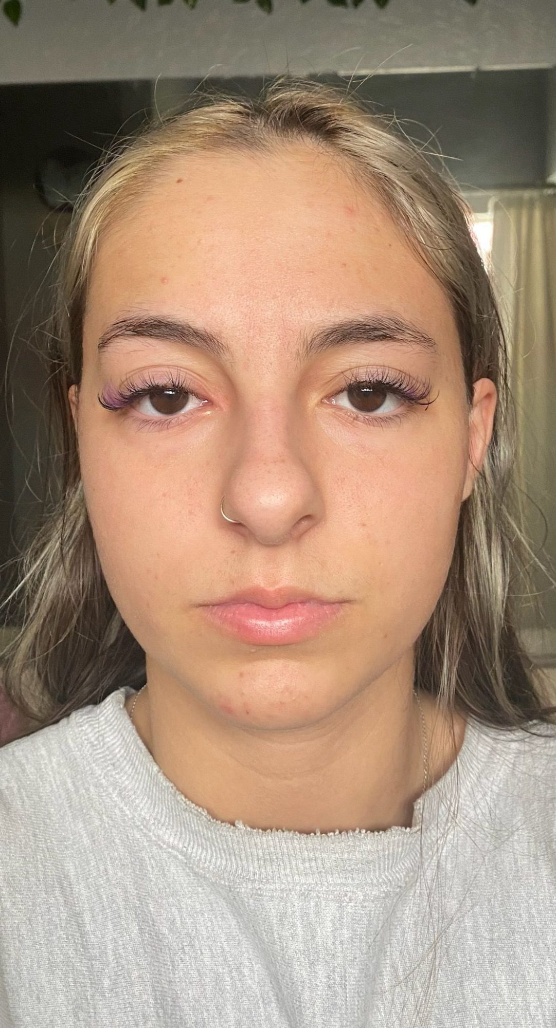 Post-treatment skin glow after diamond microneedling for rejuvenation at DERMAKI.