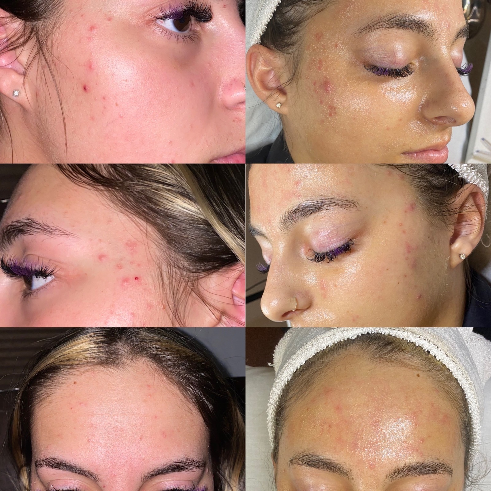 Before image of diamond microneedling treatment showing skin texture improvement for anti-aging.