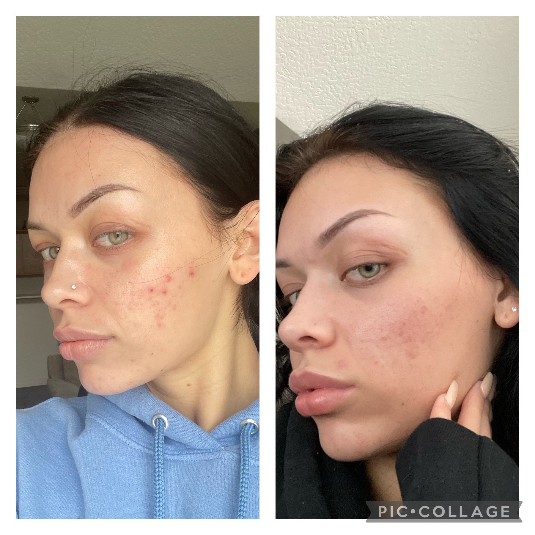 Before and after microdermabrasion treatment showcasing skin improvement next day.