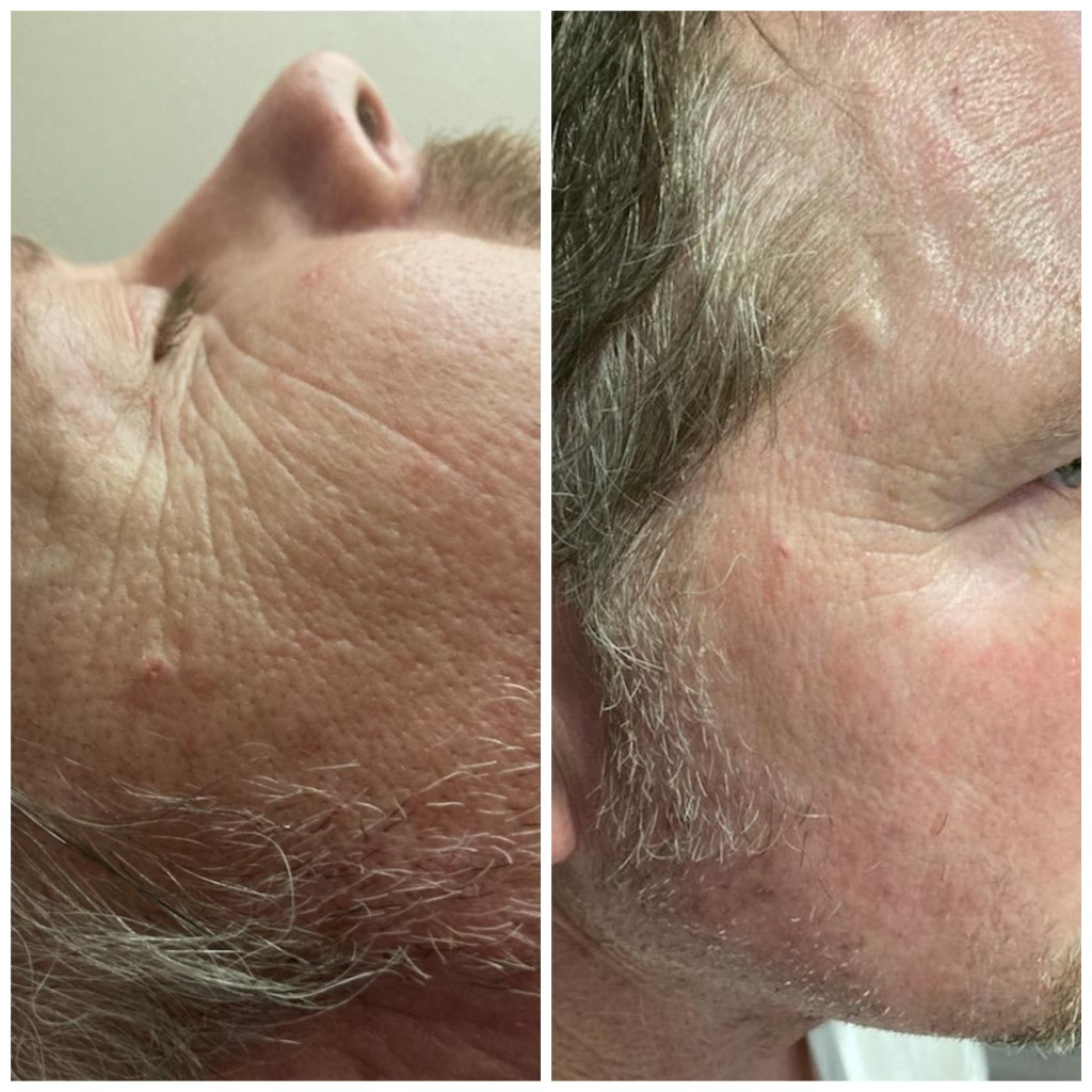 Close-up of a man receiving microneedling treatment for skin rejuvenation at a professional skincare studio.