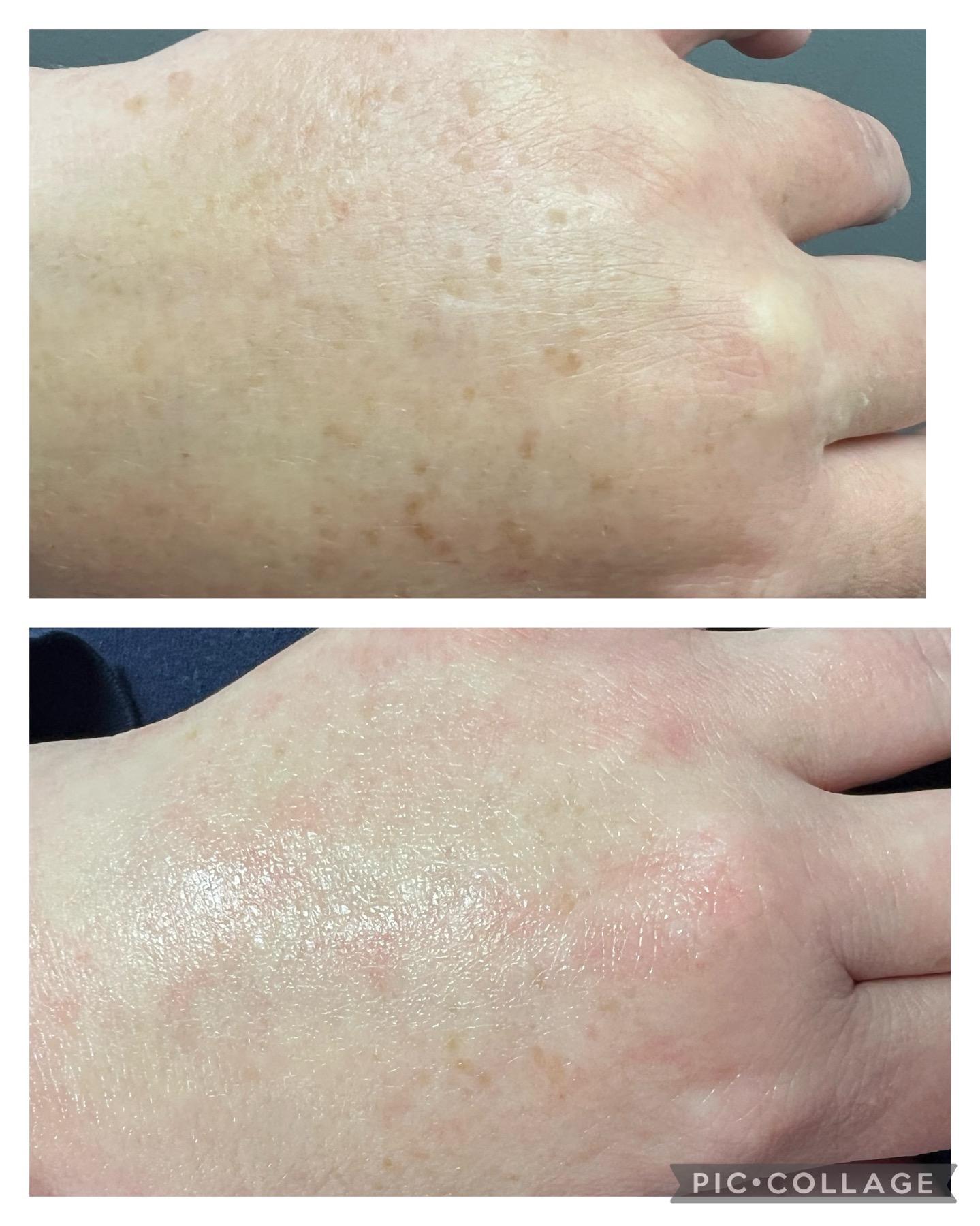 Before and after microneedling treatment on a hand, showcasing skin improvement and rejuvenation.