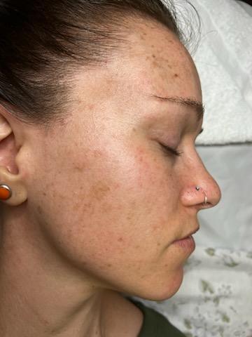 Close-up image of skin pigmentation treatment, showcasing smooth, even skin tone with Dermaki products.