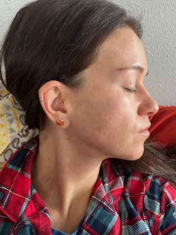 Close-up of skin showing improved pigmentation after using Dermaki products.