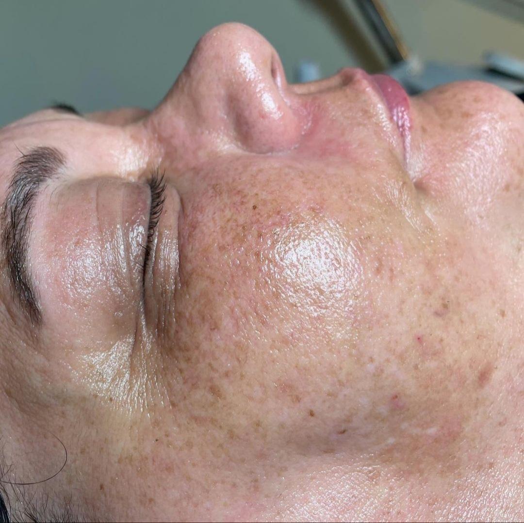 Before image showcasing the effects of pigmentation treatment with Advanced Aging Powder from DERMAKI.