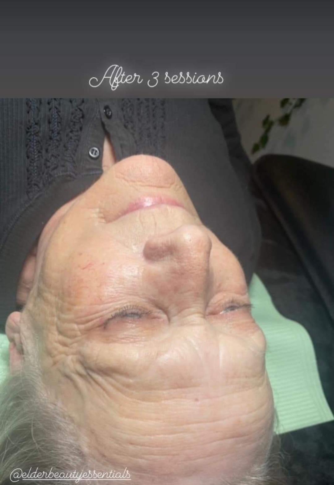 Before and after results of microneedling treatment after 3 and 6 sessions for improved skin texture.