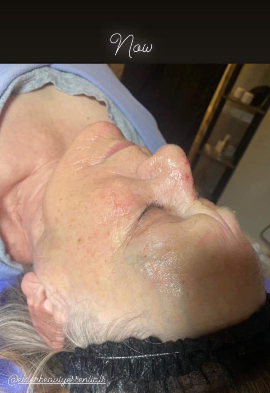 Before and after comparison of microneedling treatment results after 6 sessions on facial skin.