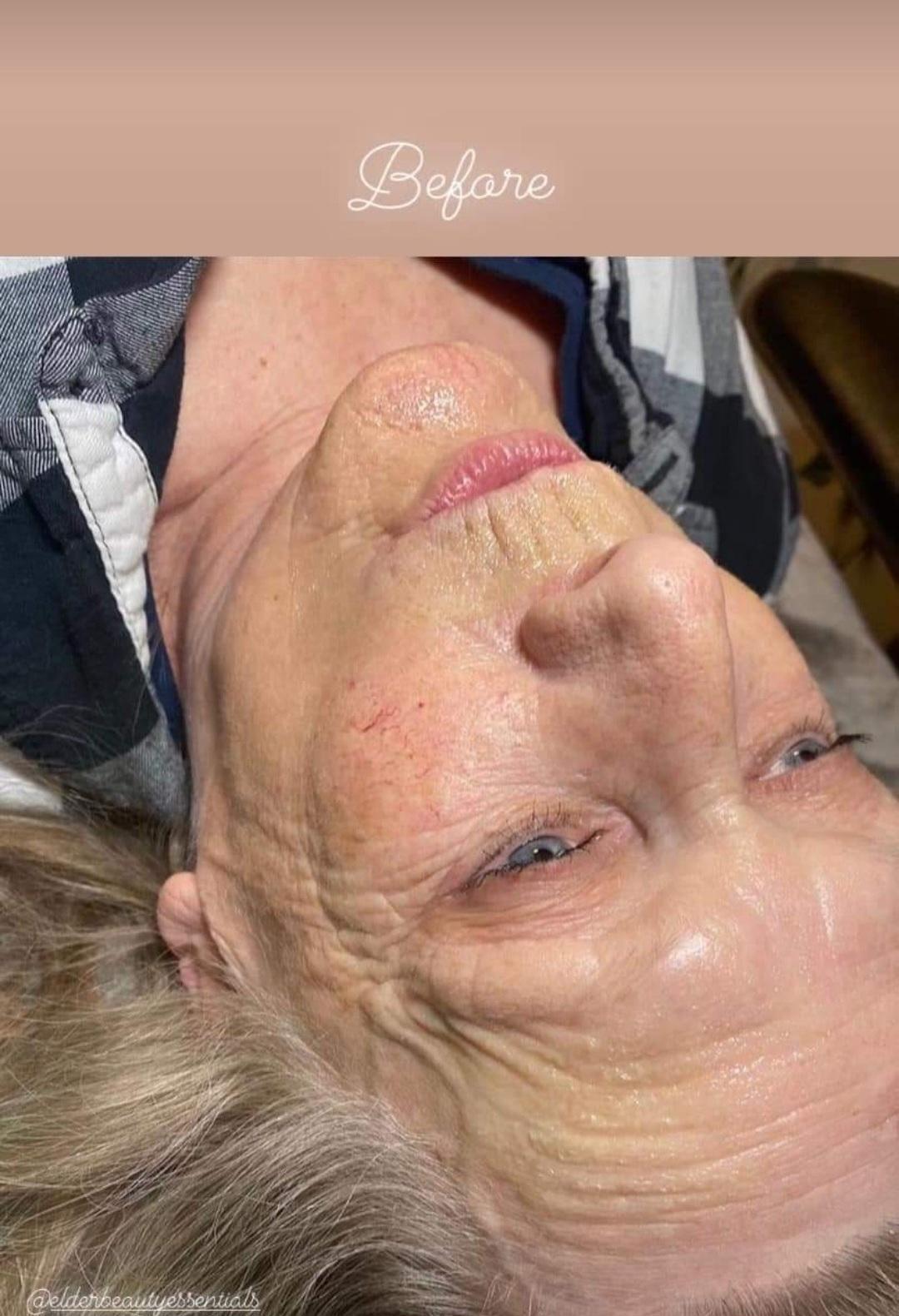 Before image showing skin condition prior to 6 sessions of microneedling treatment at DERMAKI.