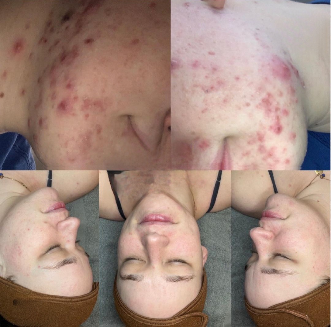 Close-up of acne skin condition, showcasing results with DERMAKIs Acne-Clarifying Line products.