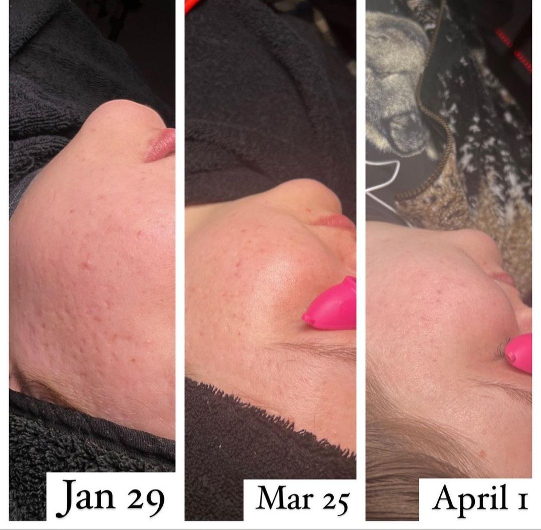 Left side view of microneedling treatment for reducing acne scars on skin.