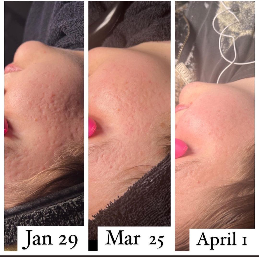 Microneedling treatment for reducing acne scars and improving skin texture at DERMAKI.