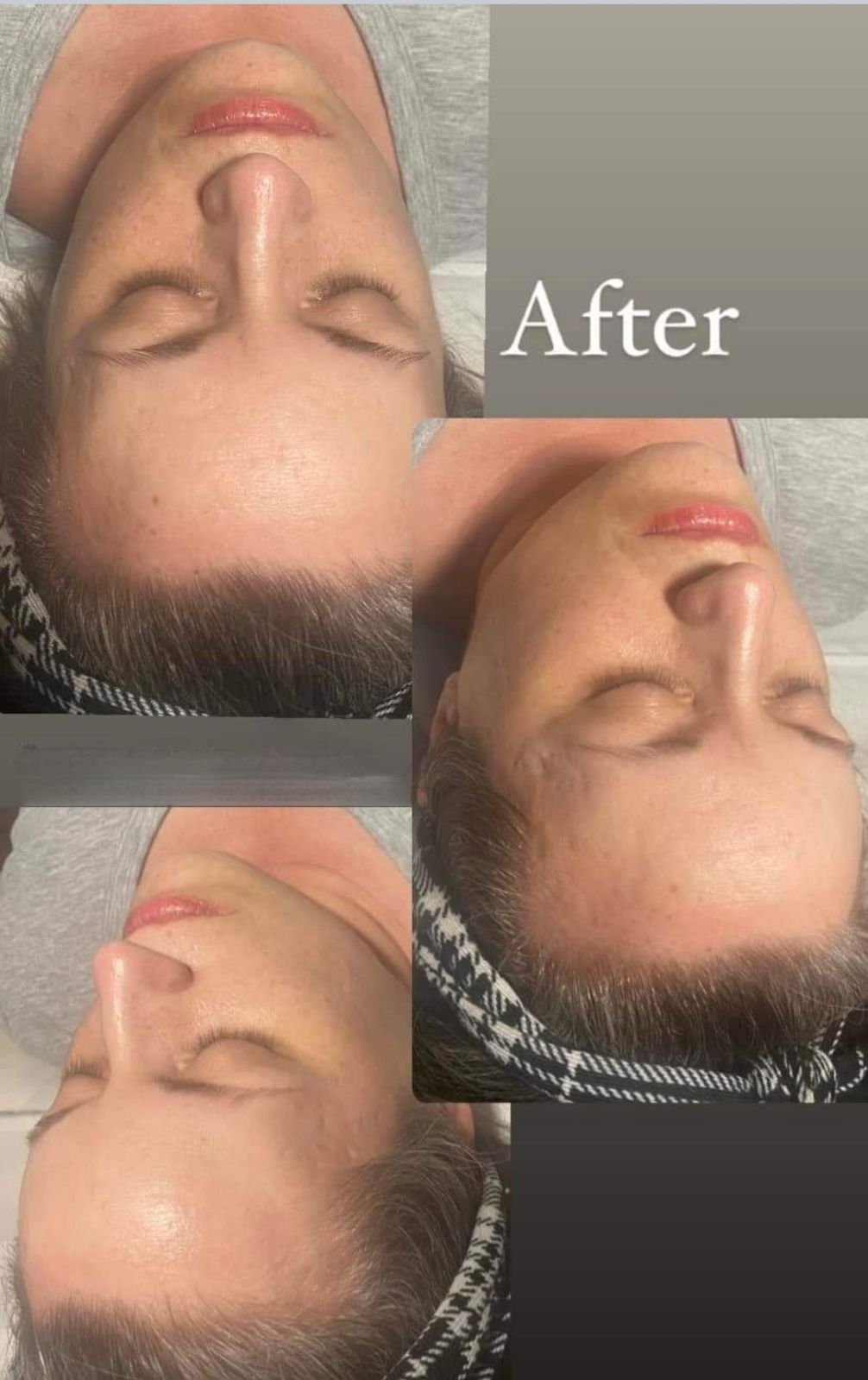 Before and after image showing skin improvement from microneedling treatment for scarring.