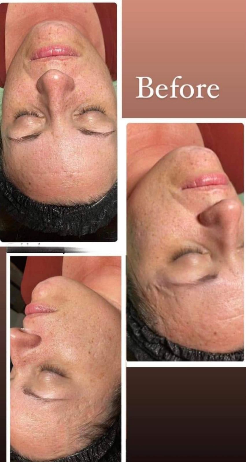 Before microneedling treatment, showing skin scarring for skincare improvement.