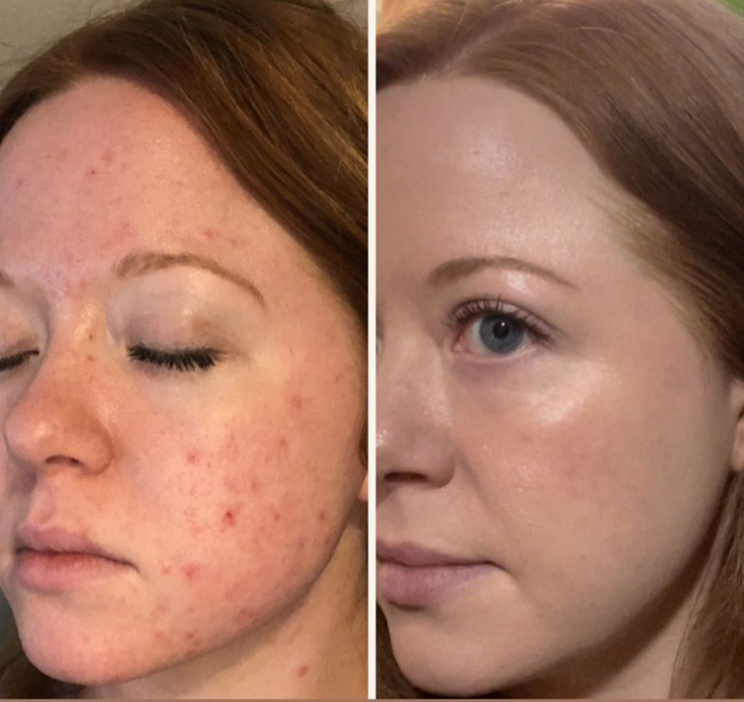 Clear skin results after using Dermaki Acne Kit, showcasing effective acne treatment.