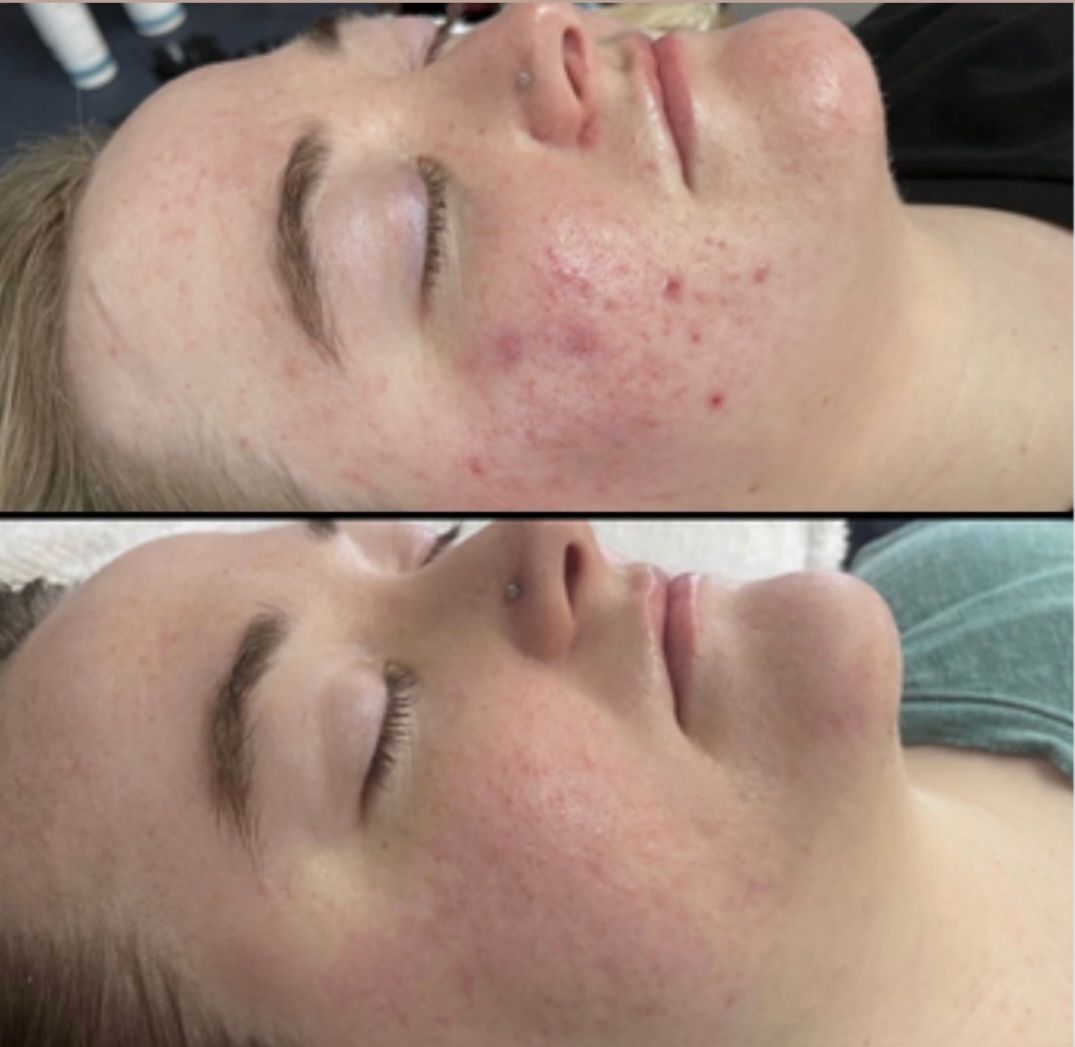 Before using Dermakis Acne Kit, showing skin with visible blemishes and imperfections.