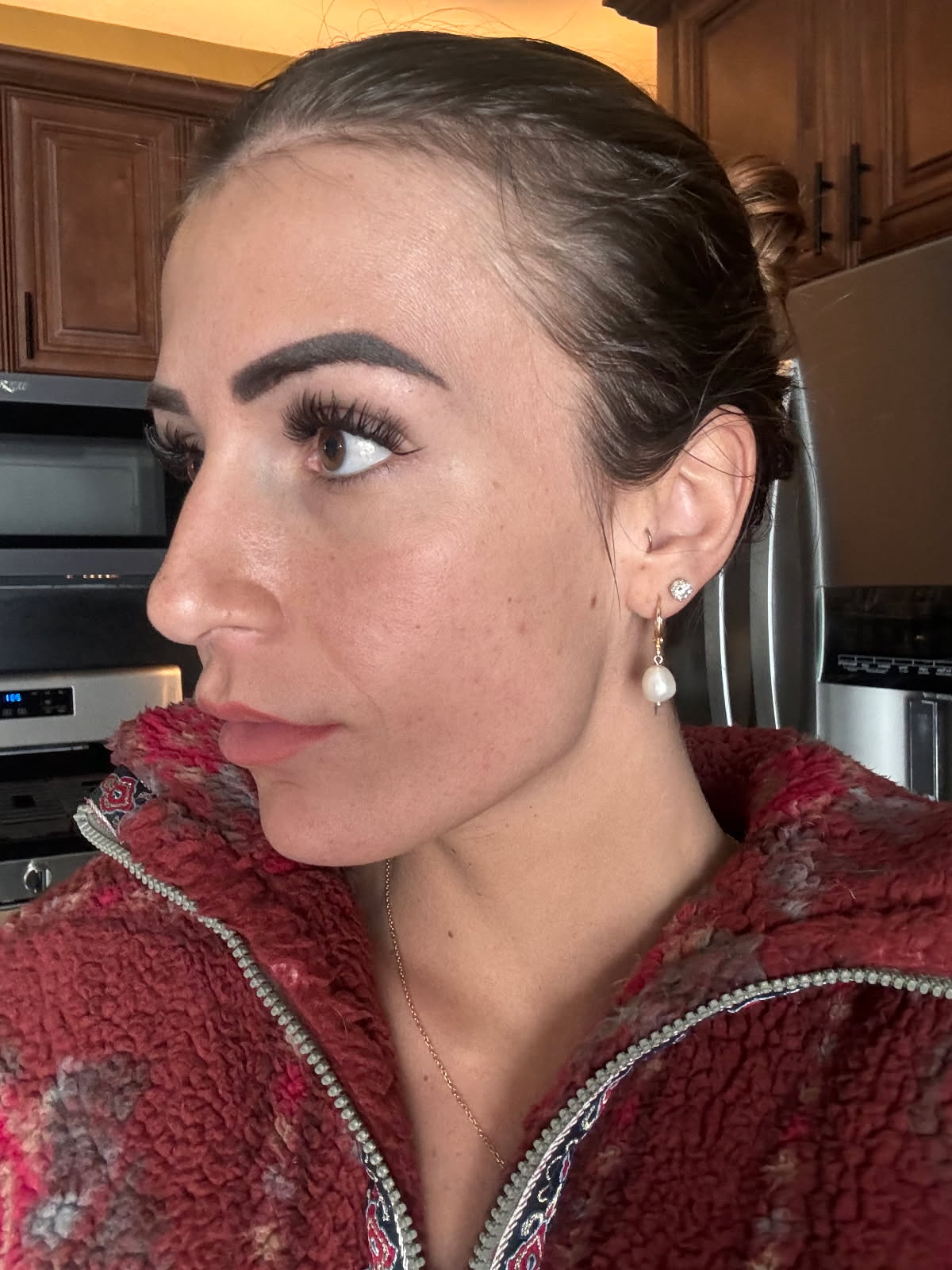 Clear skin transformation after using Dermakis Acne-Clarifying Line products.