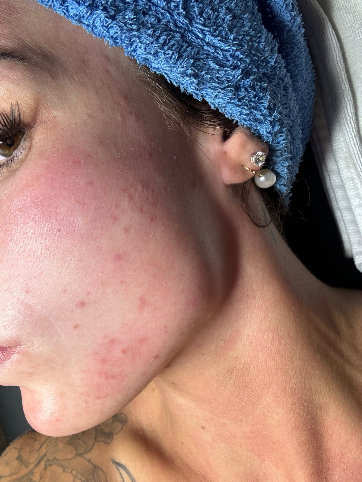 Before treatment image showing acne-prone skin, highlighting areas needing care and professional skincare solutions.