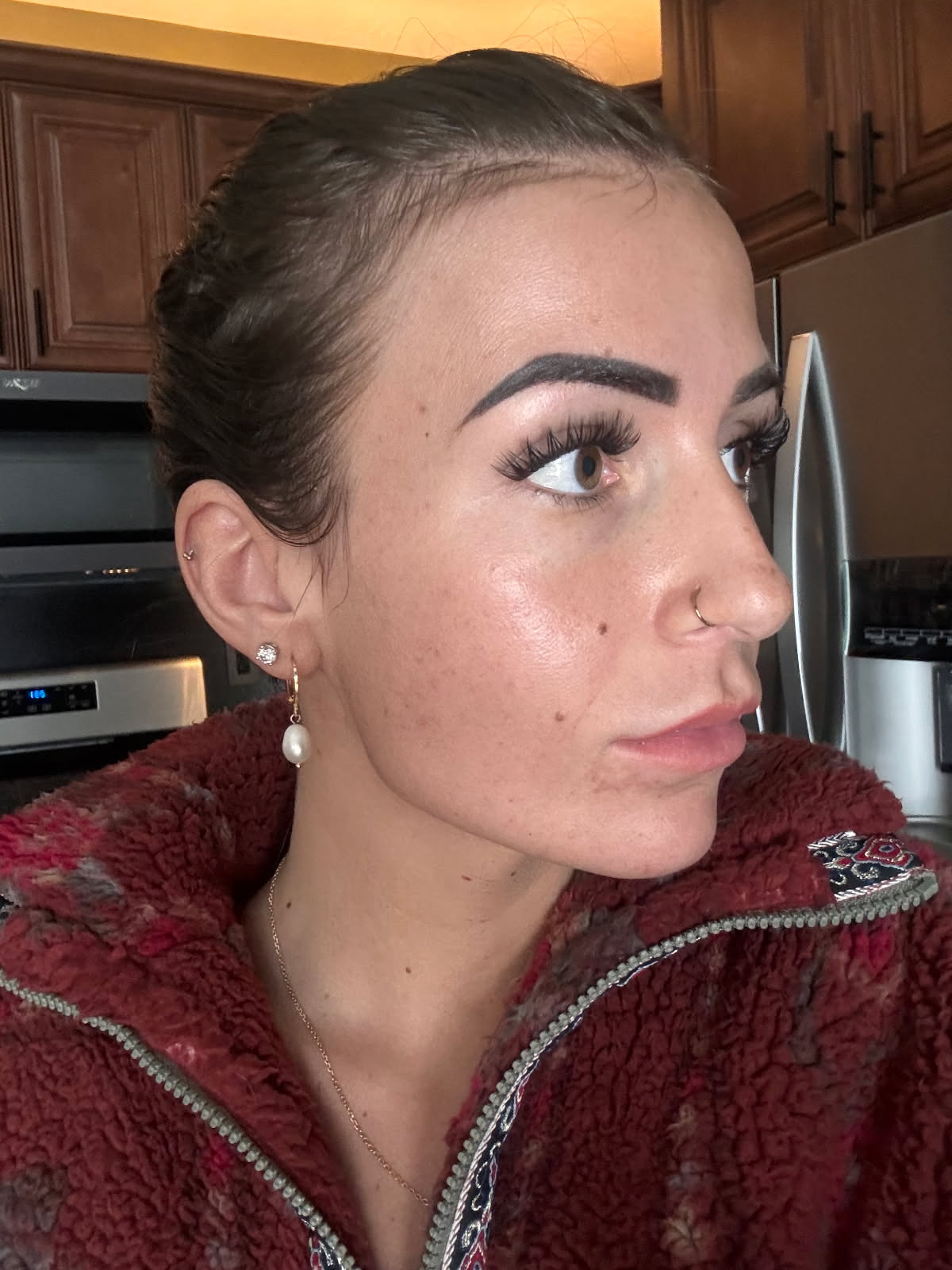 Before and after image showcasing clear skin results using Dermakis acne-claring products.