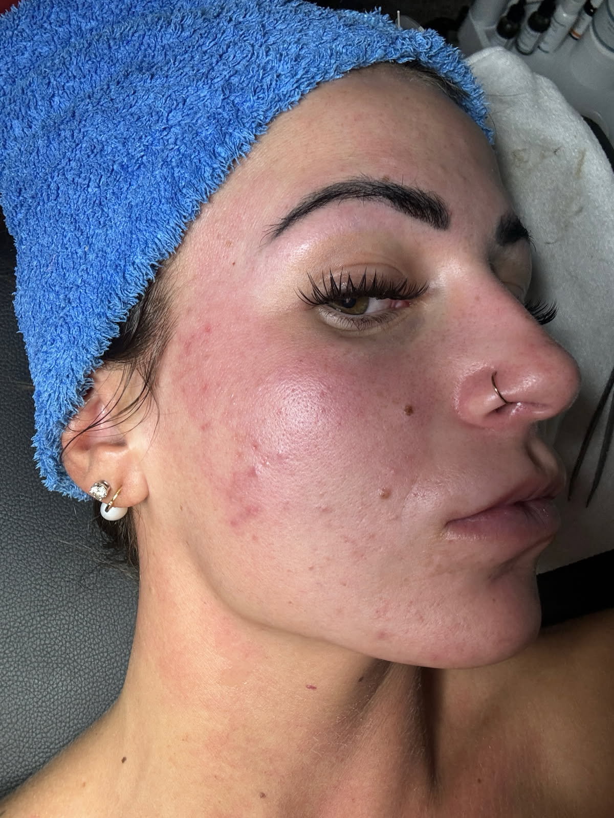 Before image showing acne-prone skin, highlighting areas for treatment with Dermakis acne-clarifying products.