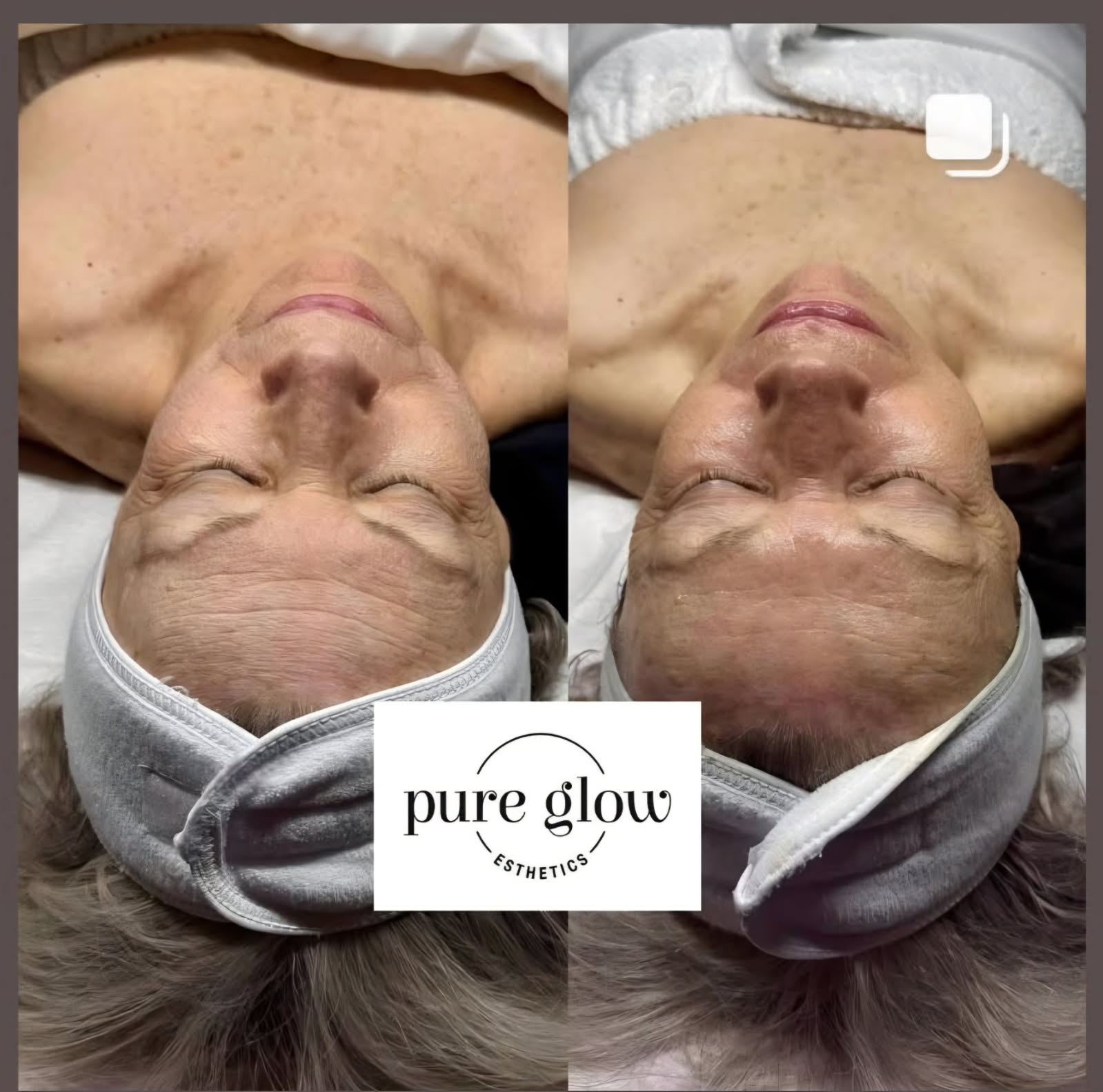 Anti-Aging Powder with Peptide Mask for youthful, revitalized skin and improved elasticity.