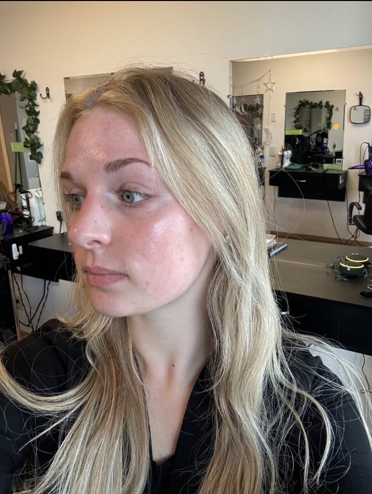Avas radiant skin transformation after 8 months using Dermakis premium skincare products.