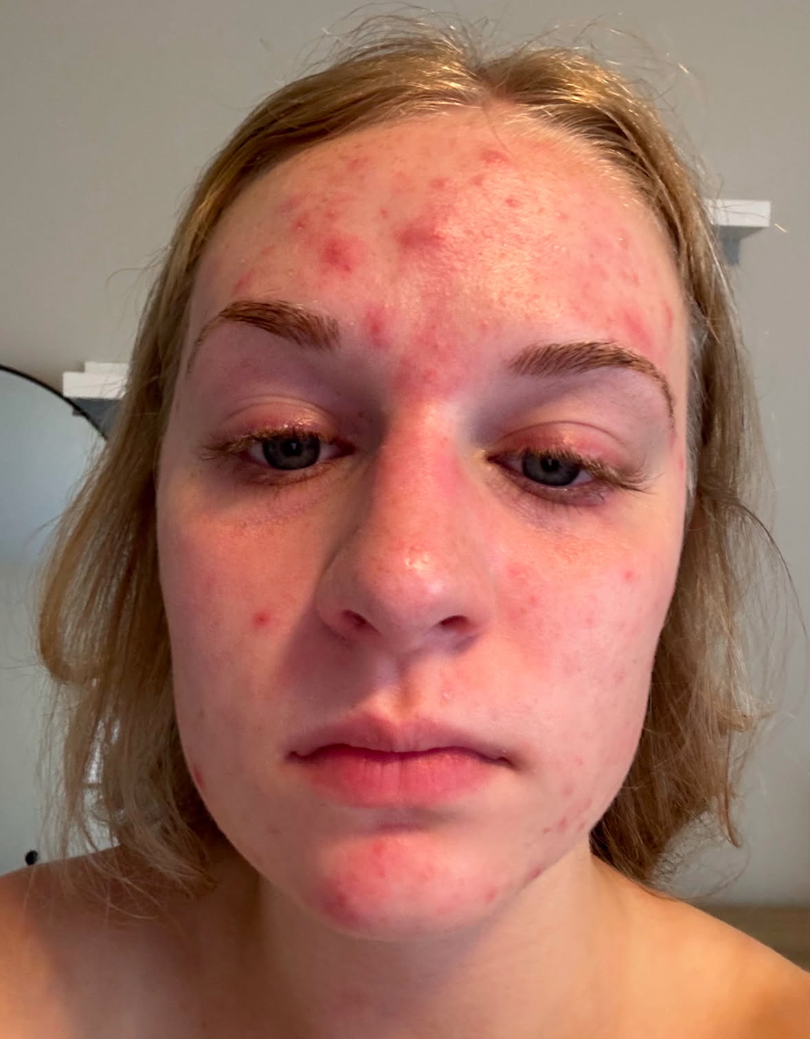 Avas skin condition before using DERMAKIs premium skincare products, showcasing visible imperfections.