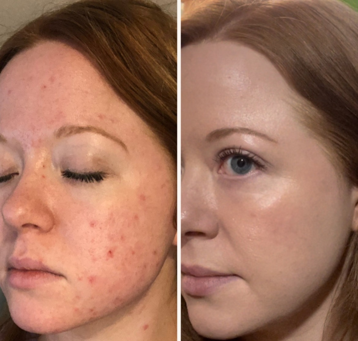 Dermaki skincare products used in treatment