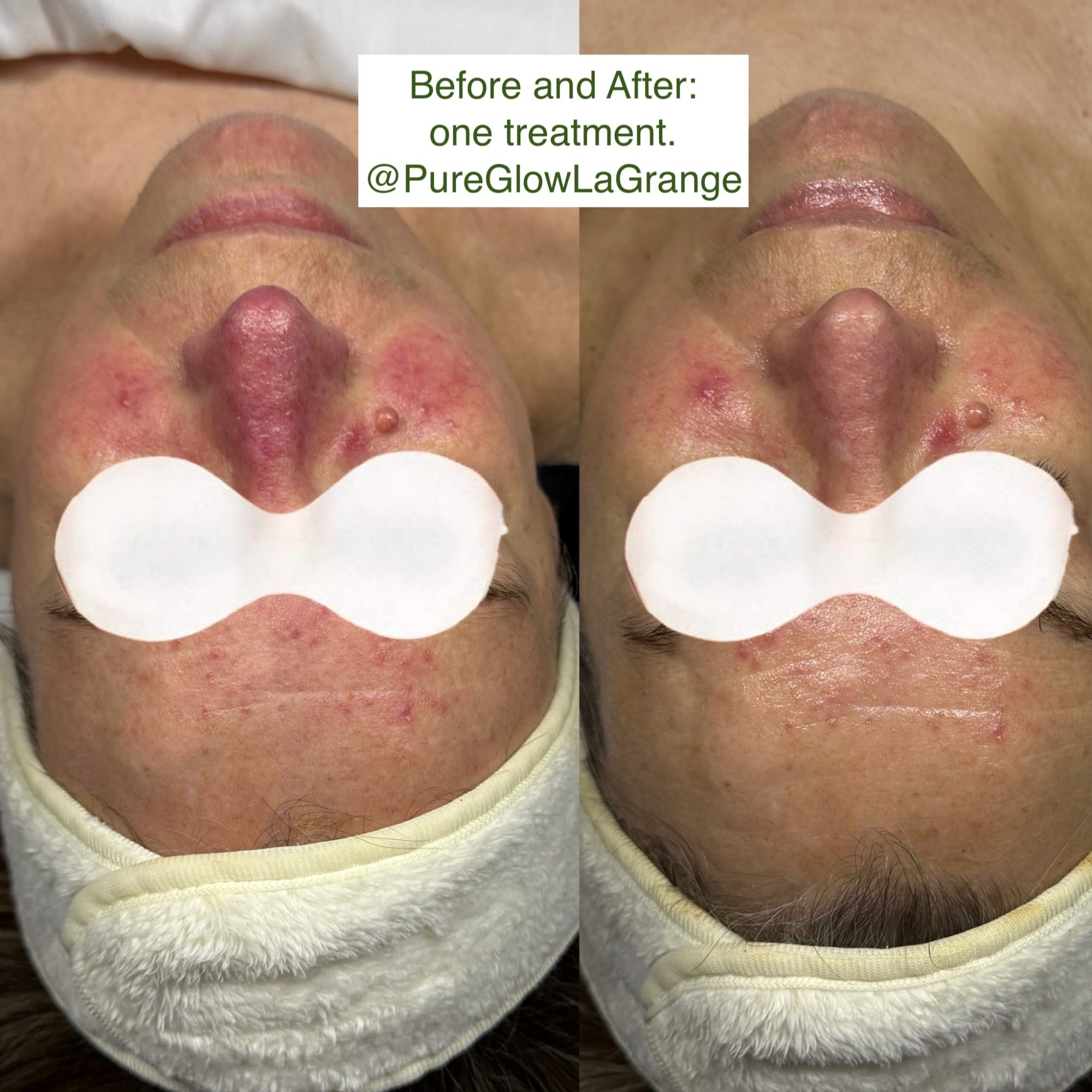 Before and after results using Dermaki products for eczema and rosacea