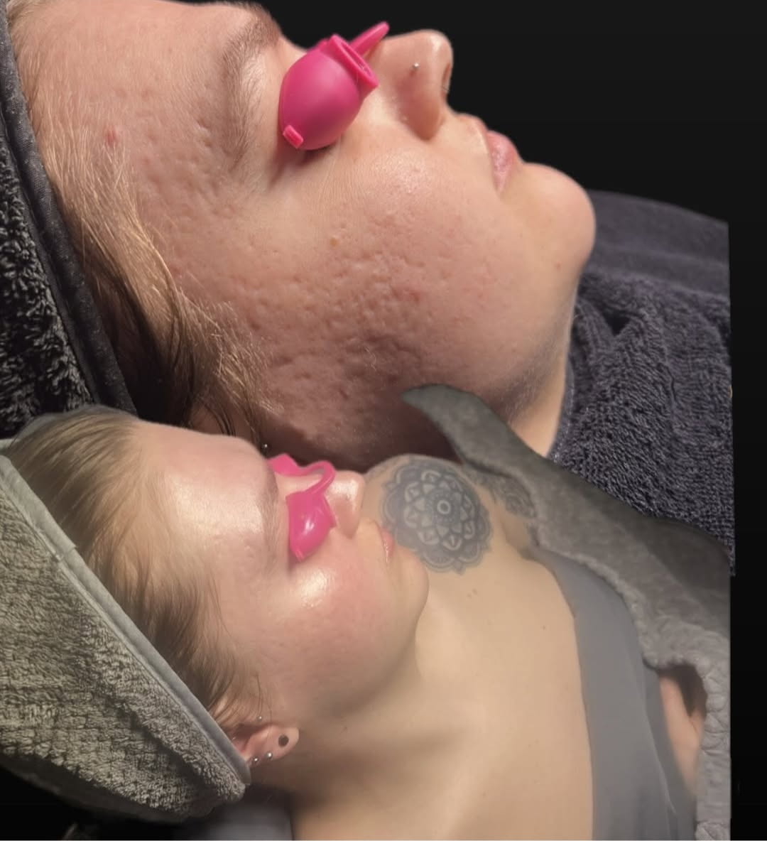 Microneedle treatment for scar reduction, promoting healing and skin rejuvenation at DERMAKI.