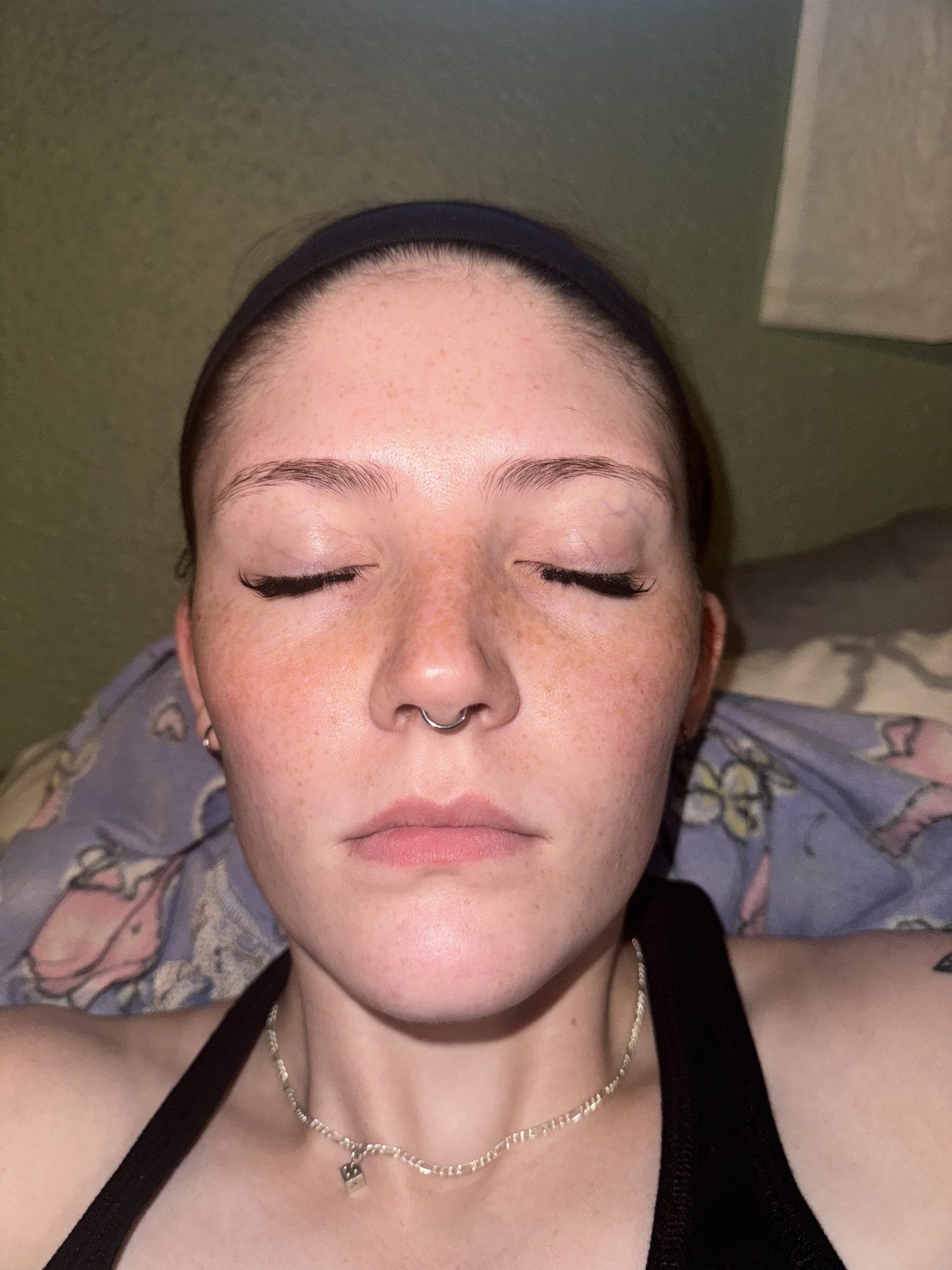 Before and after using Dermaki skincare for acne healing