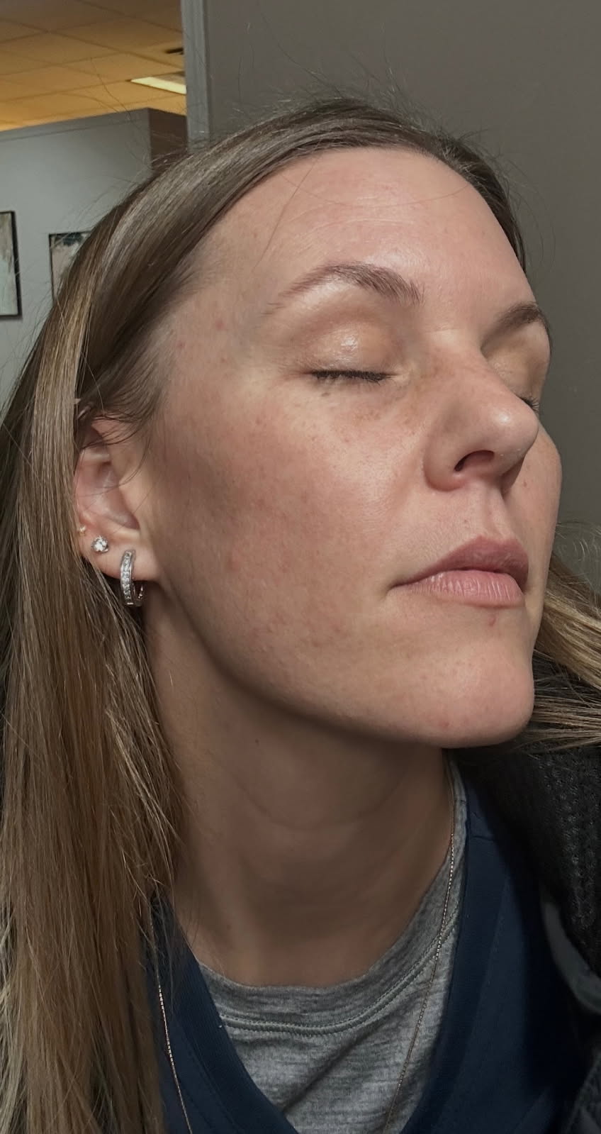 Before and after image showing skin improvement from Dermakis pigmentation treatment after 7 weeks.