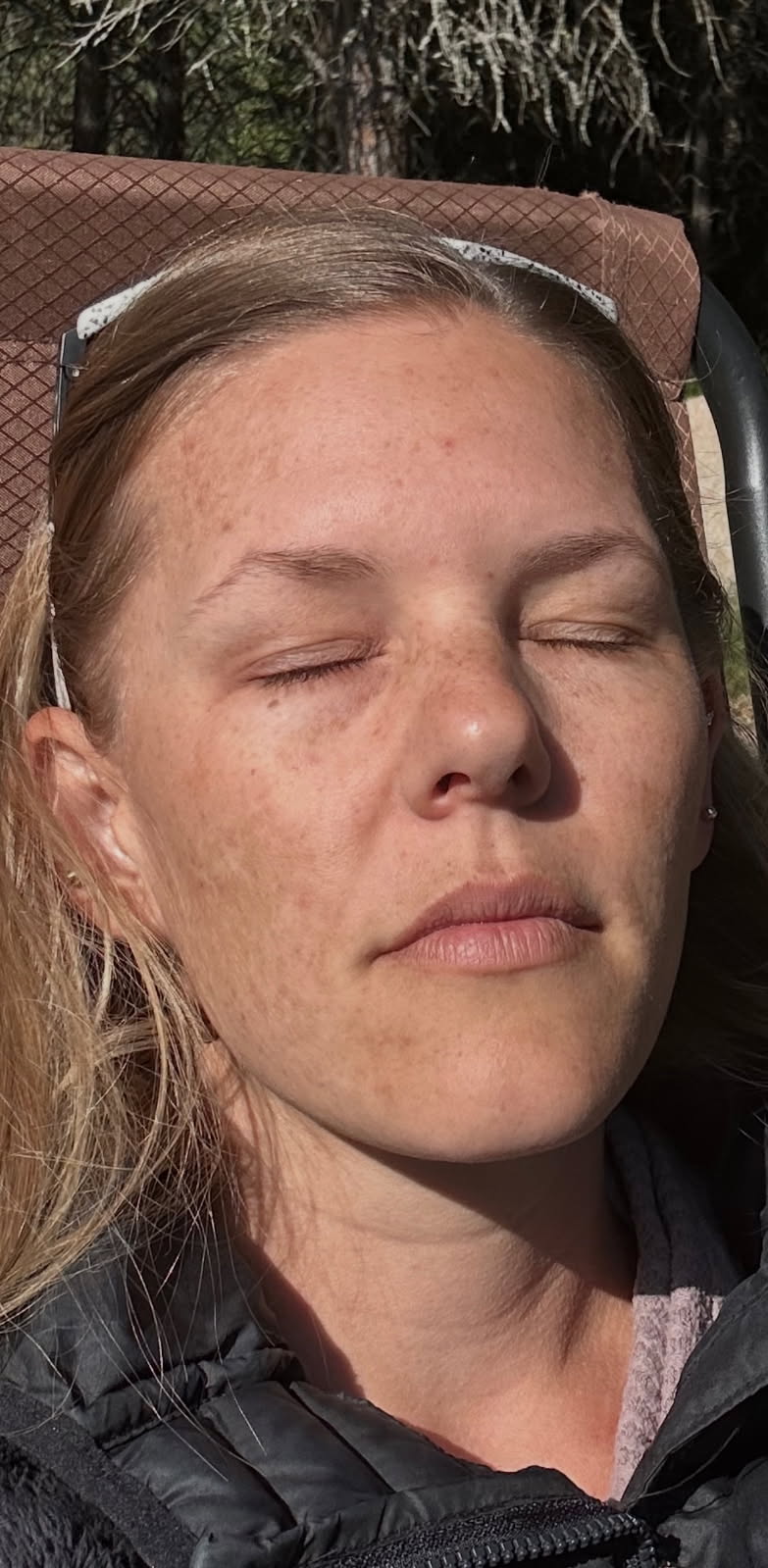 Before image showing skin pigmentation issues, taken 7 weeks prior to treatment with Dermaki products.